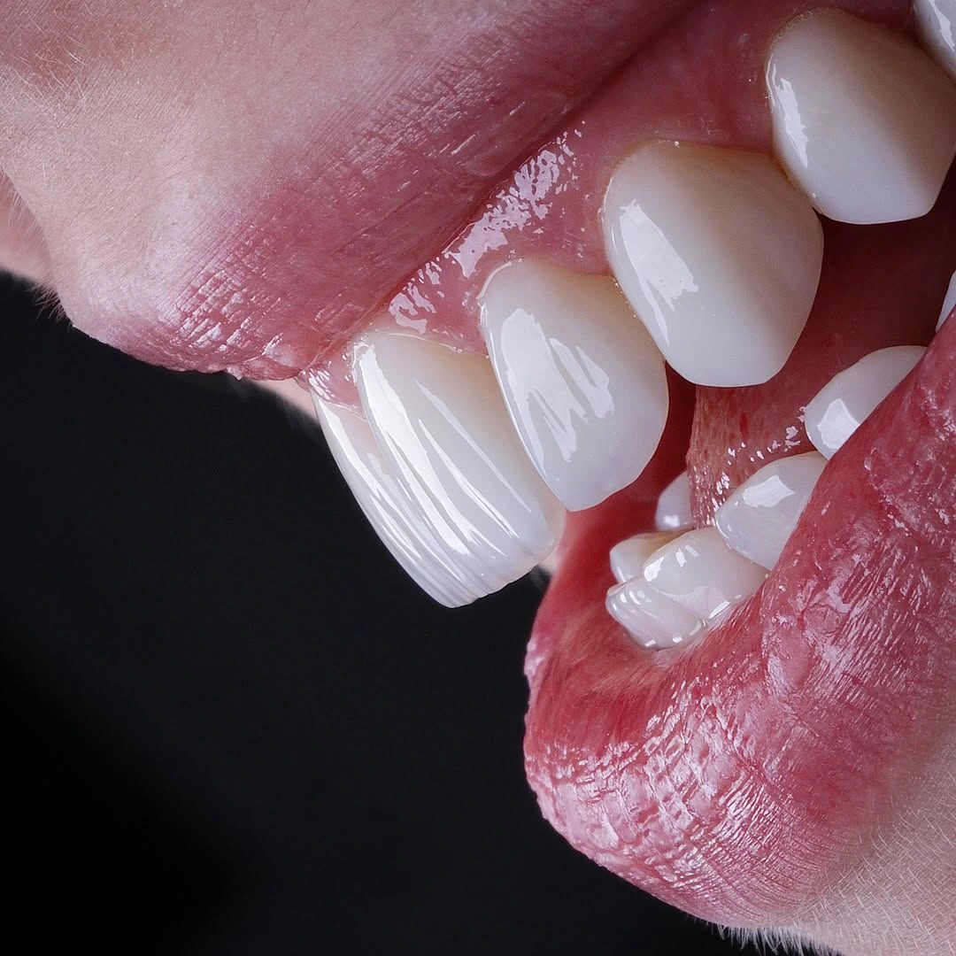 Zoom whitening treatment showing bright white teeth against skin tone