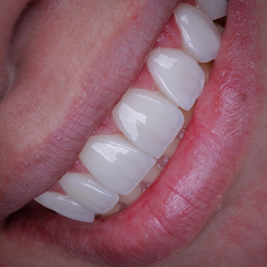 Patient A before/after veneers