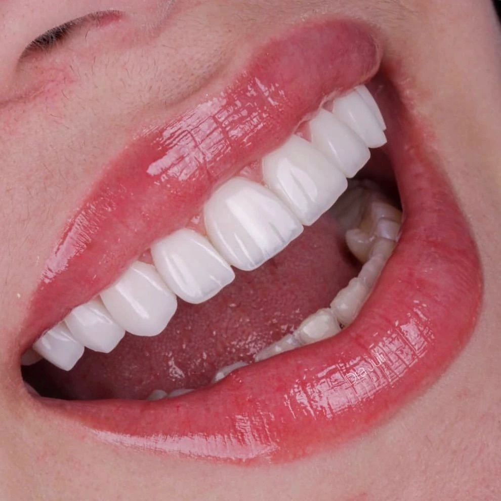 Close-up of porcelain veneers showing perfectly aligned white teeth